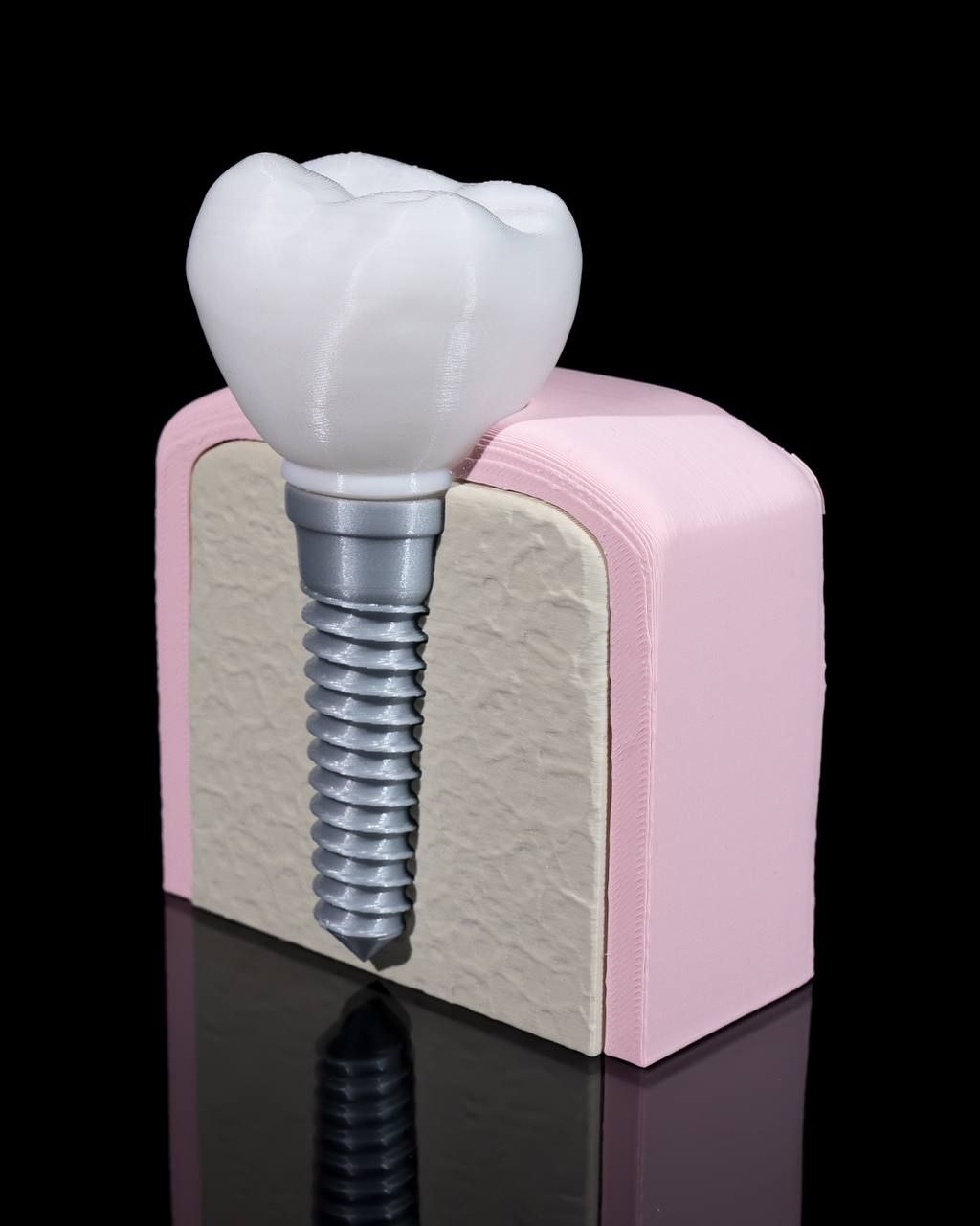 Implante Dentario